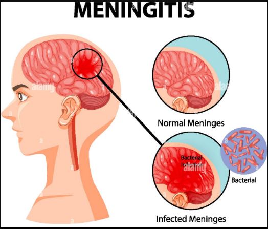 Over 400 million Africans may contract meningitis – UN